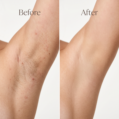 NacoVela Gentle Glow Hair Removal
