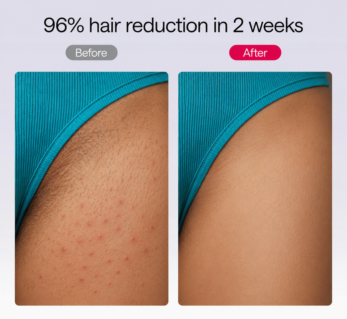 NacoVela™ Cyperus Rotundus Hair Reduction Oil | Post-Shave Hair Care