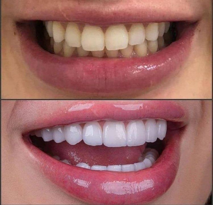 Purple Whitening Strips (Gen 2)